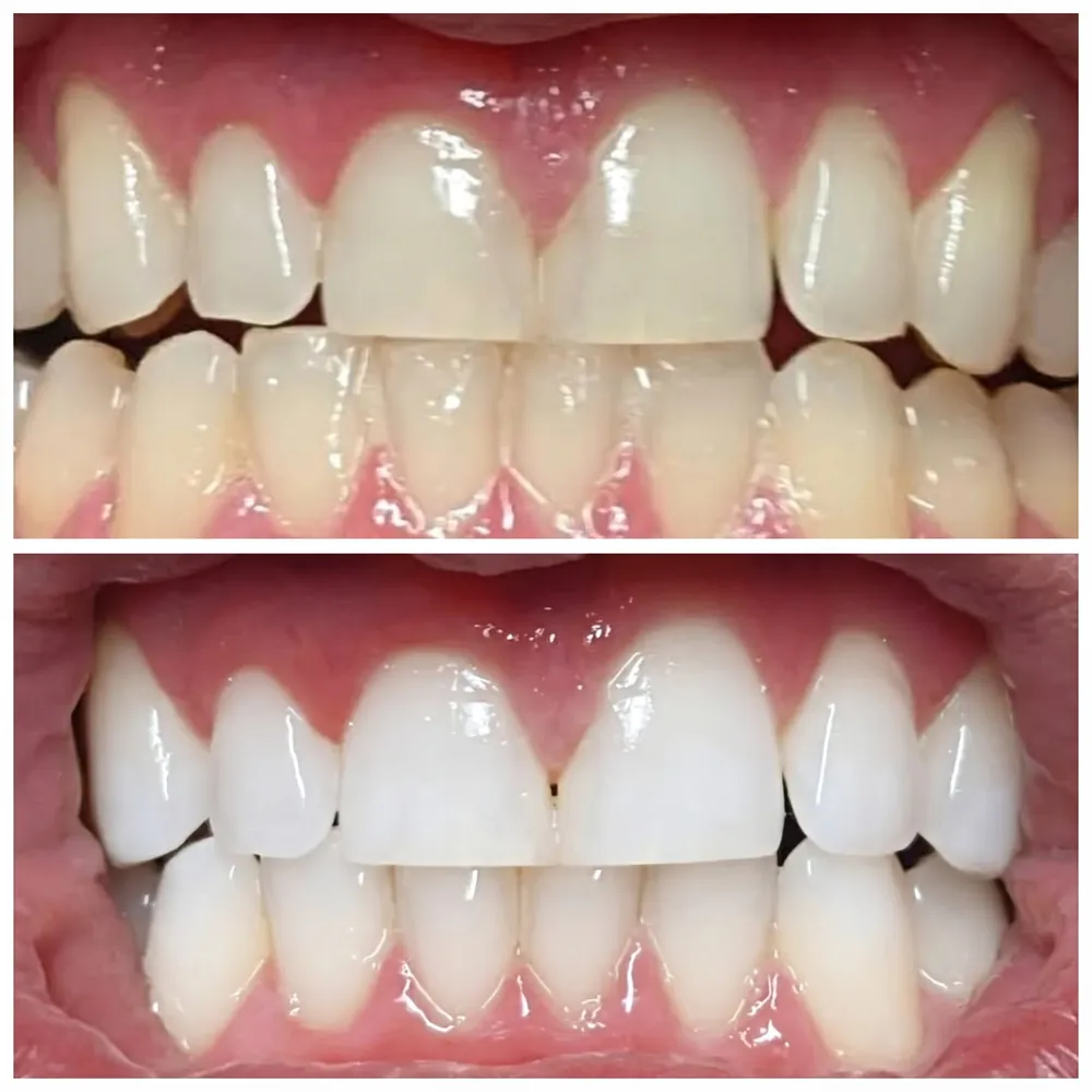 Foto de dientes antes (arriba) y después (abajo) del blanqueamiento