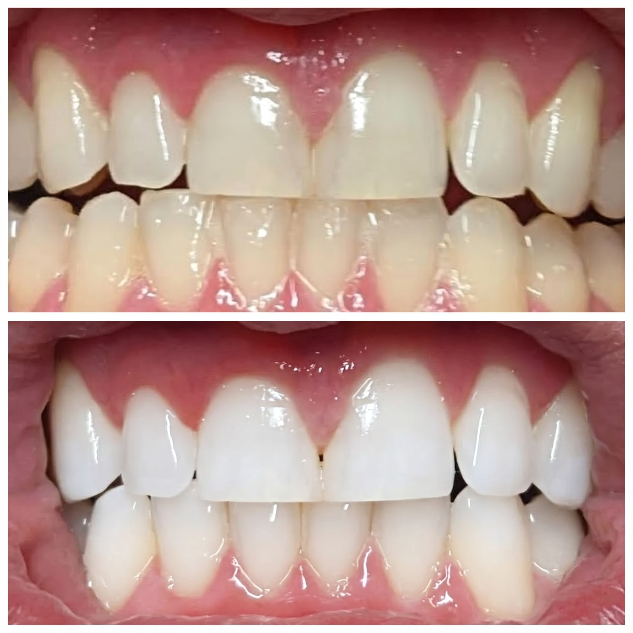 Antes y después del blanqueamiento dental